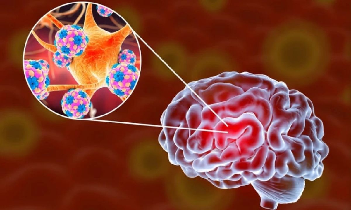 Những điều cần biết về bệnh n&atilde;o m&ocirc; cầu