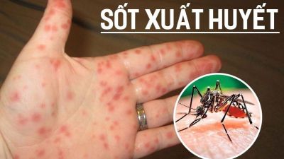 Sốt xuất huyết dengue có dấu hiệu cảnh báo sớm không?