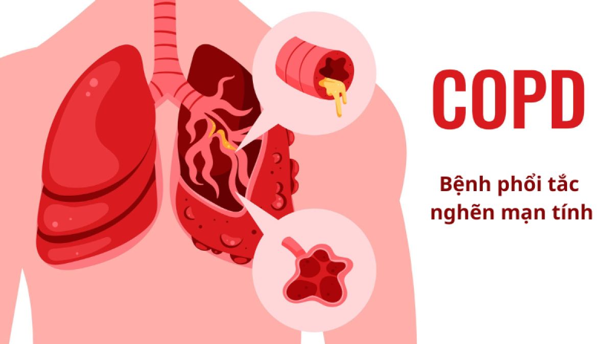 Bệnh phổi tắc nghẽn mạn tính (COPD)