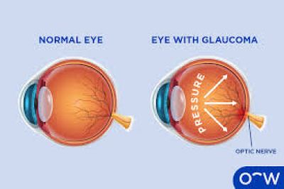 BỆNH GLAUCOMA (CƯỜM NƯỚC)