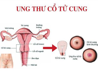 Ung thư cổ tử cung và những điều cần biết