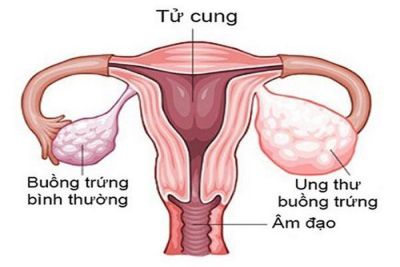 Ngày Thế giới phòng chống Ung thư Buồng trứng 08.05.2024